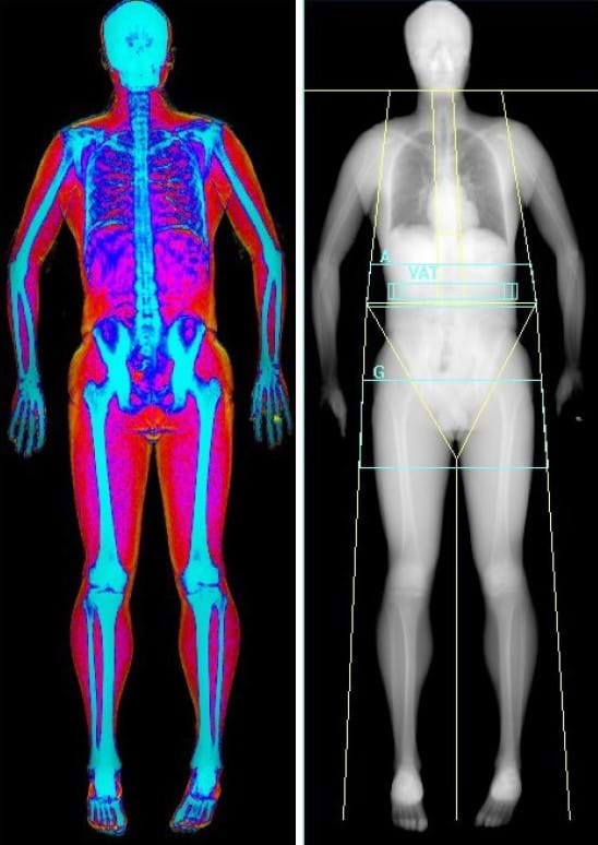 Body composition evaluation with DEXA scan. Muscle, fat and bone